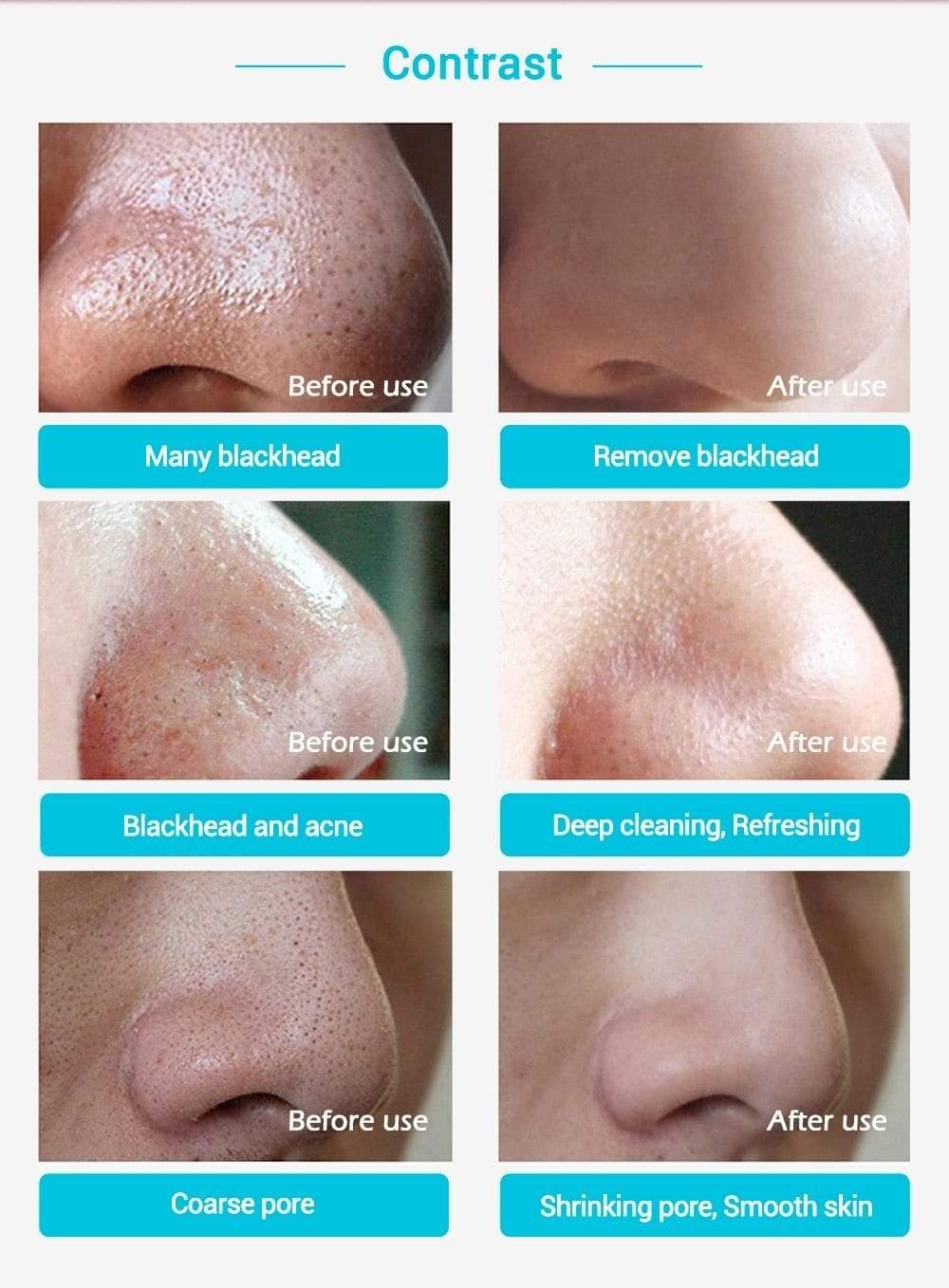 New Style  Nose Blackhead Removal  and Peeling Acne Treatment - For Women USA